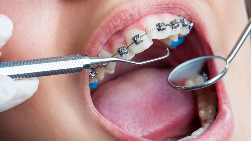 تعرف على أطباء تقويم اسنان والعمر المناسب لتقويم الأسنان!