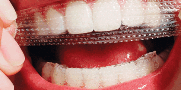أنواع تبييض الأسنان واسعارها
