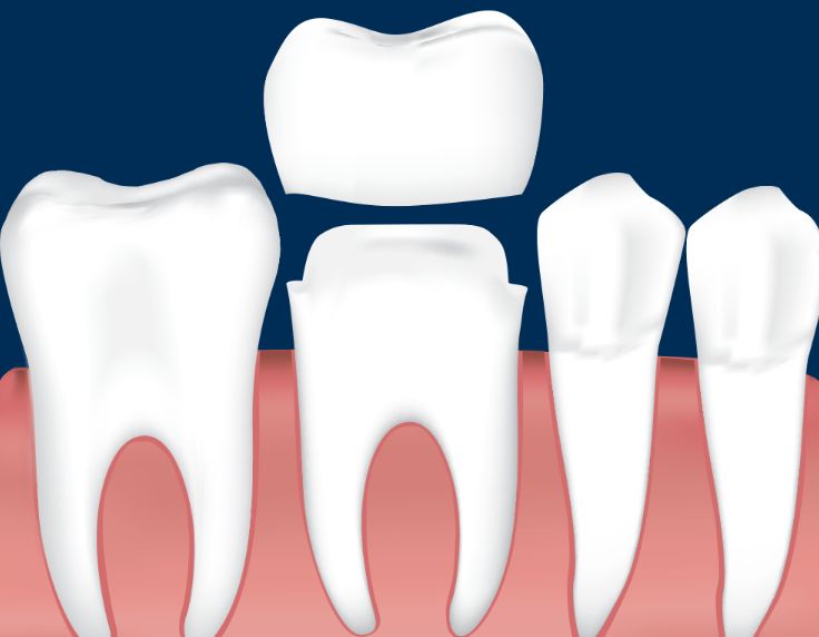 أنواع تلبيسات الأسنان