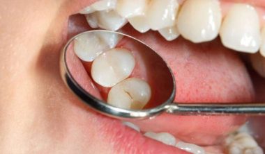 أنواع حشو الأسنان