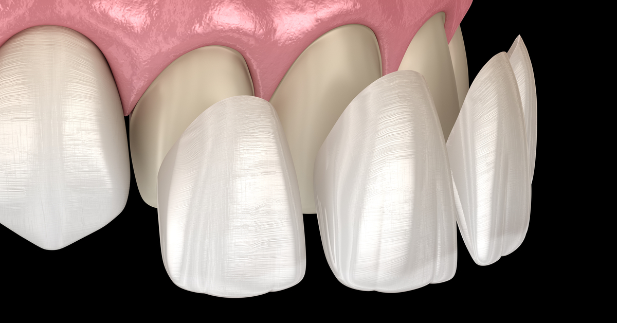 أنواع فينير الأسنان