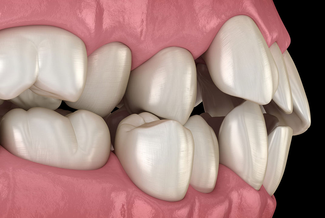 تفاصيل أكثر حول ادخال الاسنان البارزة بدون تقويم والتحديات التي تواجهها!