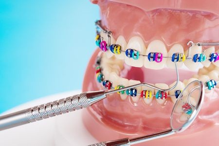 اسعار ادوات تقويم الاسنان