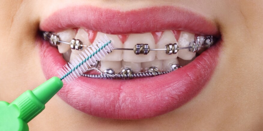 العناية بالأسنان والتقويم بعد التركيب