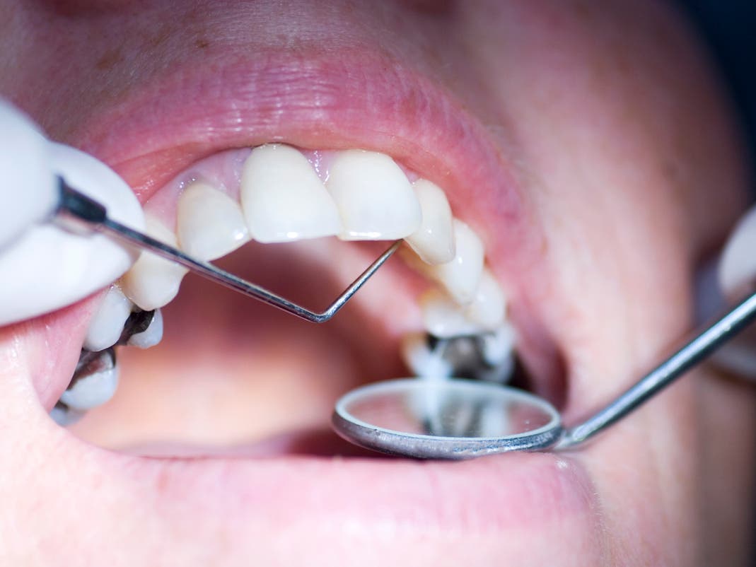 اكتشف طرق تبييض حشوات الأسنان الامامية وأهم المواد المستخدمة في تصنيعه؟
