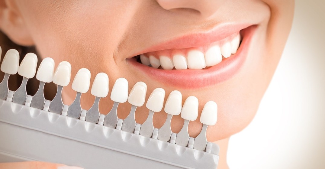 نتائج تركيب عدسات الأسنان