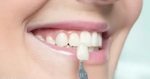 تعرف على كيفية تركيب طبقة على الاسنان وأهم أنواعها!