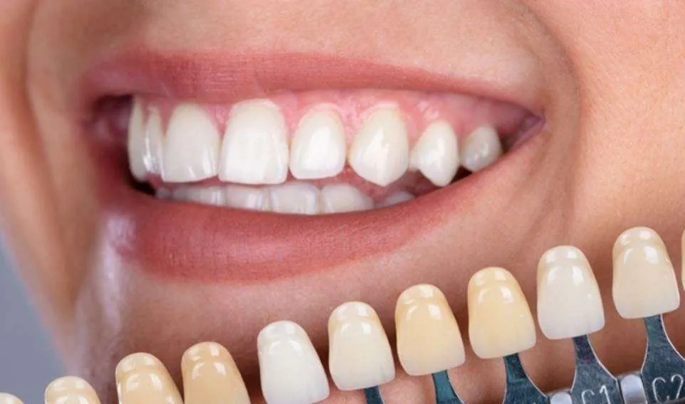 تغيير تركيبات الاسنان