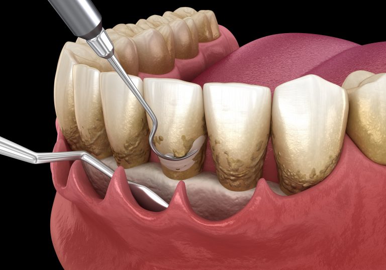 معلومات مميزة عن تنظيف جير الاسنان وأبرز الطرق لمنع ظهوره مرة أخرى؟