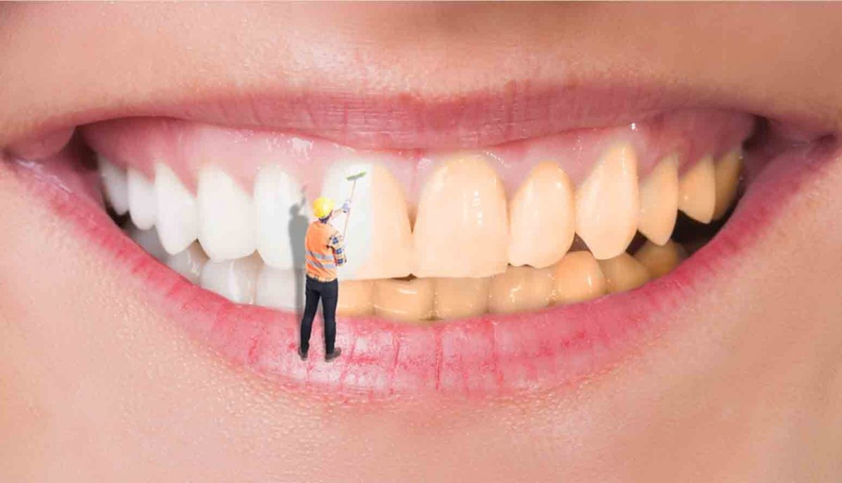 كم تدوم مدة تبييض الأسنان؟
