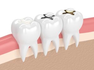 تعرف على عروض حشو الاسنان وكم مدة بقاءه على الأسنان؟
