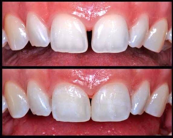 ما هي الأسنان المتفرقة؟