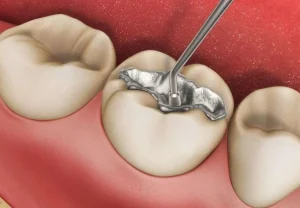 تعرف أكثر على حشوة الاسنان كم سعرها وما هي أهم مميزاتها؟