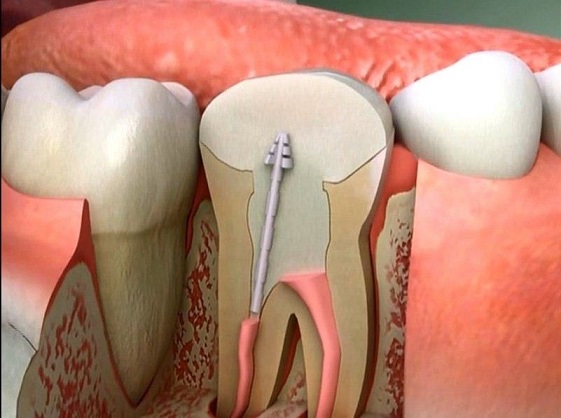 زراعة عصب الاسنان