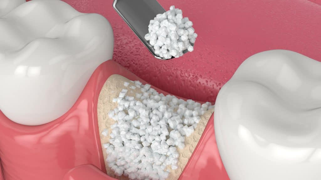 معلومات هامة عن عملية زراعة عظم في الاسنان وما هي أسباب ذوبان هذه العظام؟