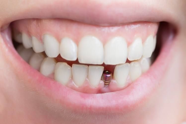 تعرف أكثر على زراعة وتد اسنان وما هي فوائده؟