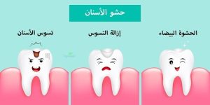 تعرف معنا على سعر تركيب حشوة الاسنان في مصر 2023 وأنواع الحشو المتوفرة!