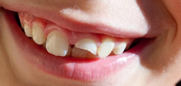 ما هي أسباب تكسر الأسنان؟