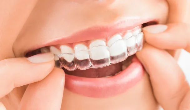 طريقة تنظيف مثبت الأسنان الشفاف