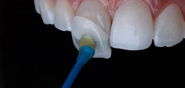 أنواع تركيب عدسات الأسنان