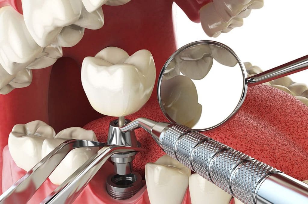 ما هو السن المناسب لإجراء عملية زراعة الأسنان ؟