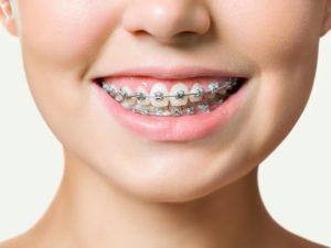 معلومات هامة عن عمل تقويم الاسنان وما هو العمر المناسب لتركيبه؟