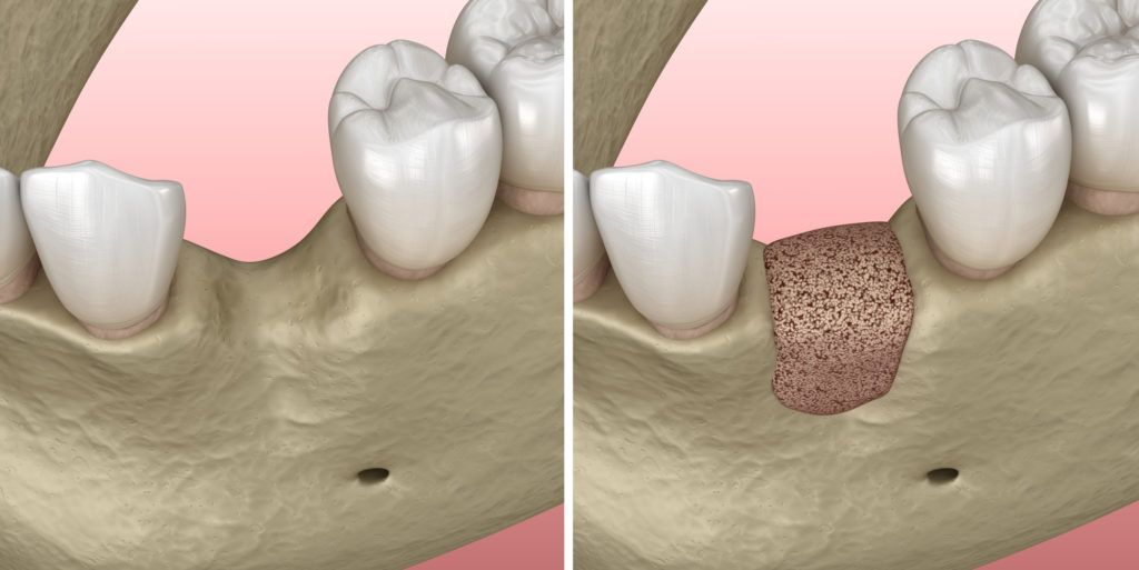 عملية زراعة العظم للاسنان