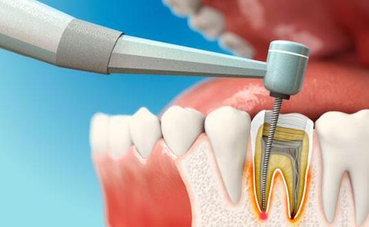 فوائد زراعة عصب الاسنان