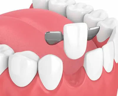 كيف يتم تركيب جسر الاسنان الامامية