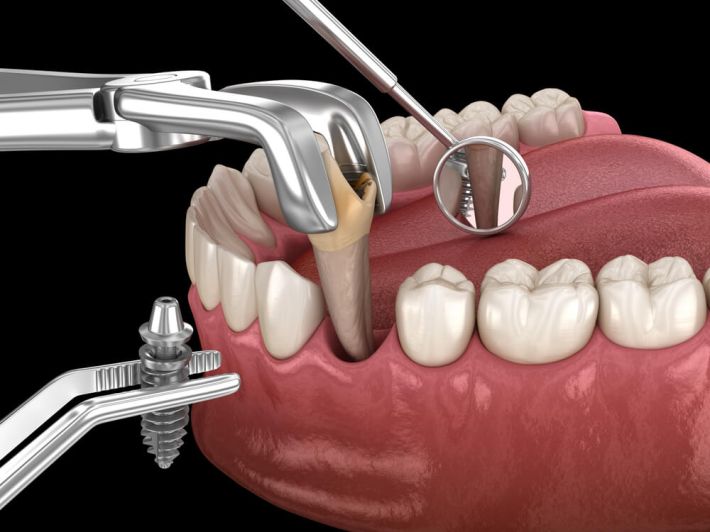 كيف يتم عملية زراعة الأسنان؟