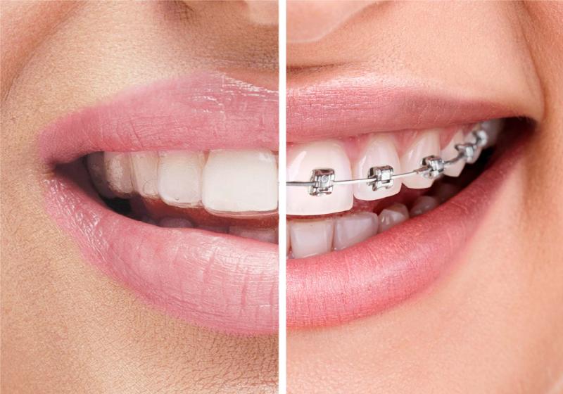 الفرق بين تقويم الأسنان العادي والشفاف