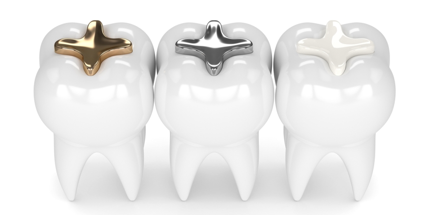 ما الفرق بين حشو السيراميك و انواع حشوات الاسنان الاخرى