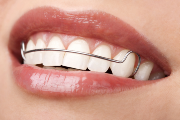 ما هو مثبت الاسنان بعد التقويم؟