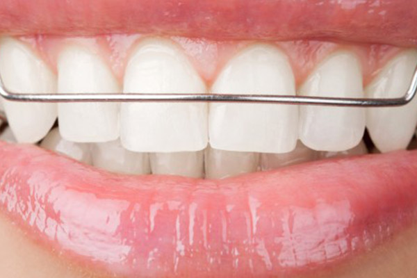 ما هي أنواع تقويم الأسنان المعدني؟