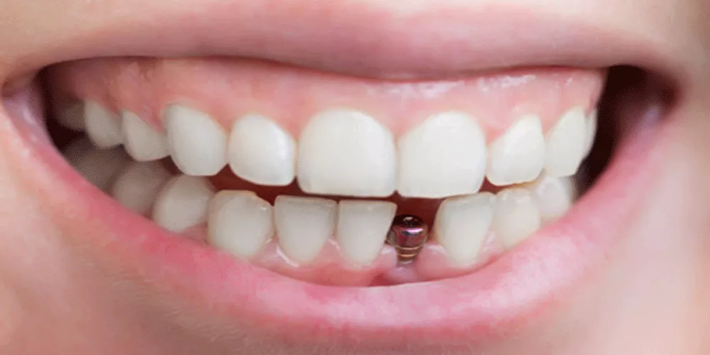 ما هي بدائل تركيبات الأسنان الثابتة ؟