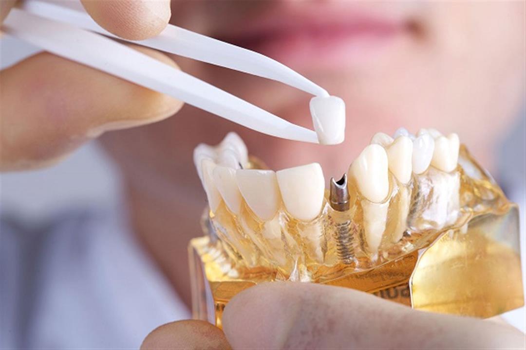 ما هي سلبيات زراعة الاسنان؟