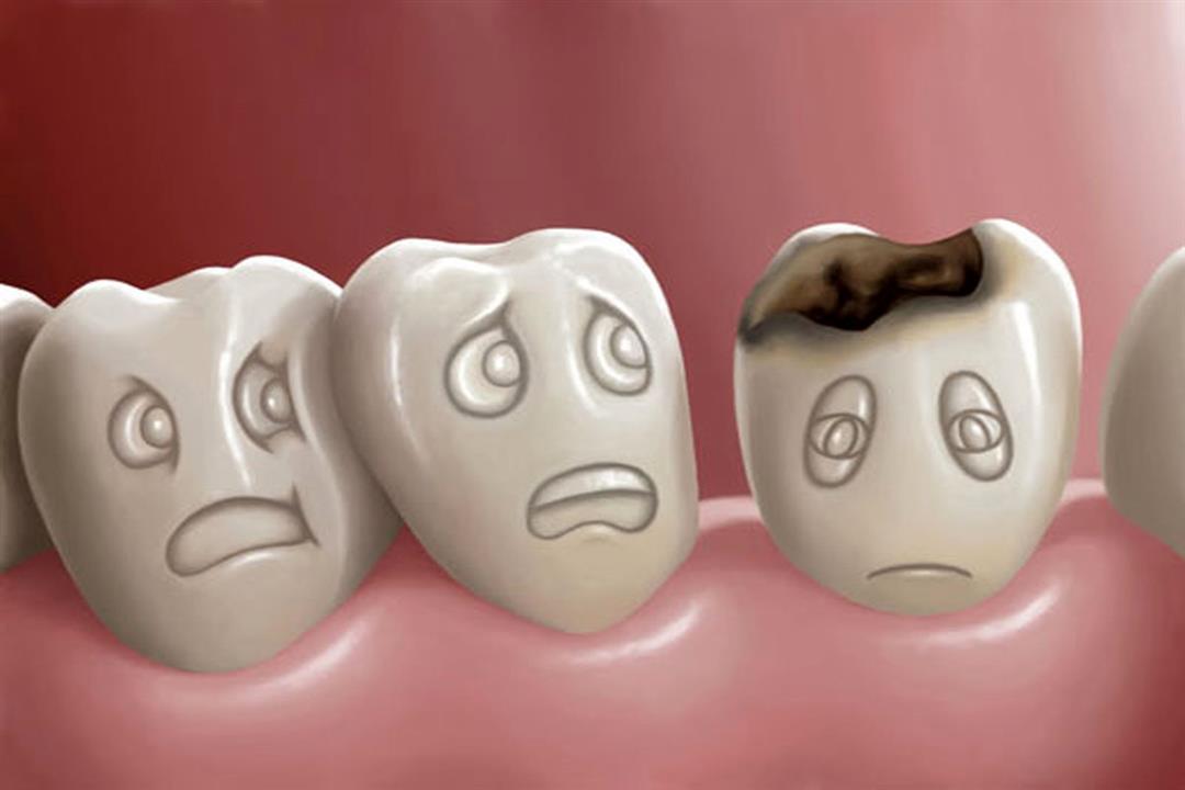 ما هي علامات تسوس الأسنان؟