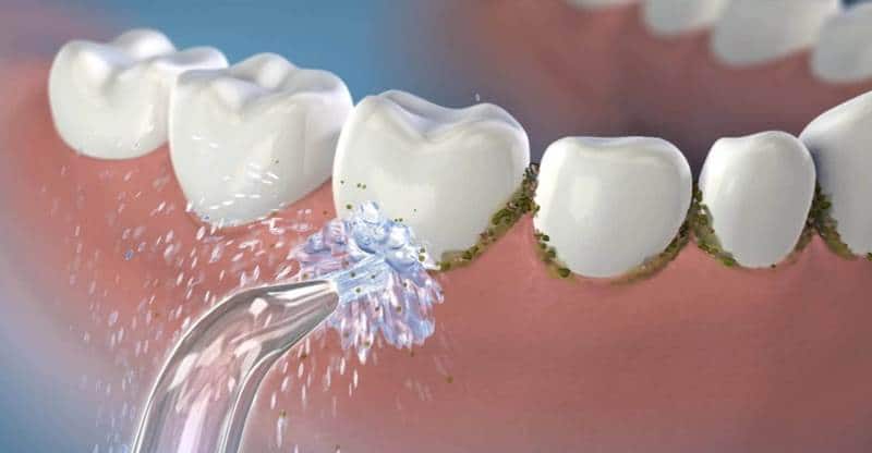 ما هي عملية تلميع الاسنان؟