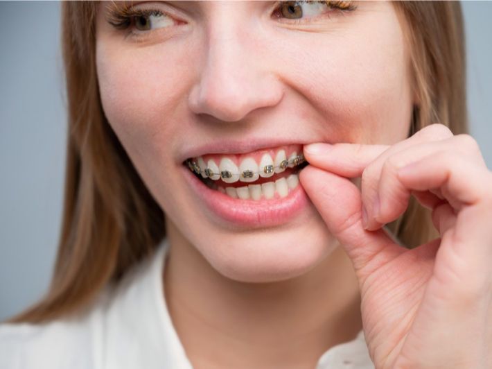 ما هي قواعد تركيب تقويم الاسنان ؟