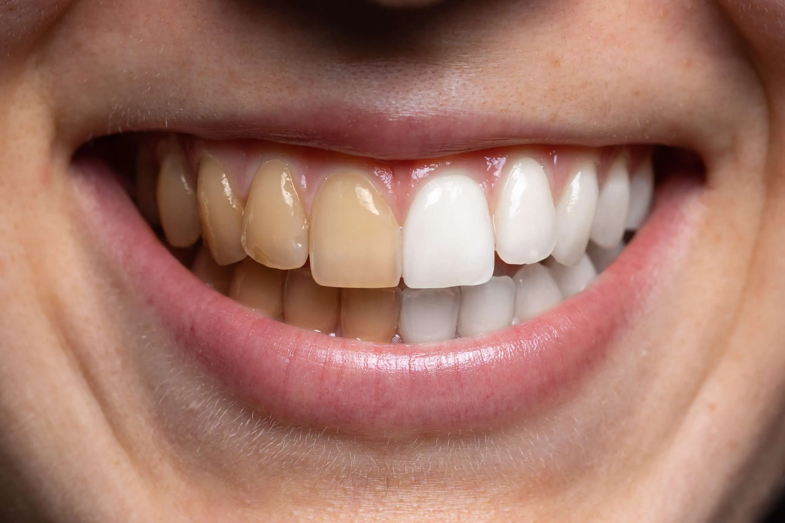 ماهي الألوان الأخرى التي من الممكن إزالتها في تبييض الأسنان؟