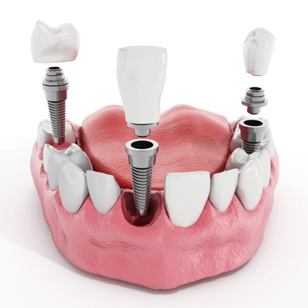 مزايا عملية زراعة عظم السفلي في الاسنان