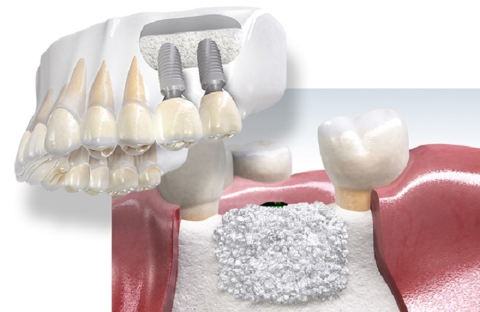 مزايا عملية زراعة عظم في الاسنان