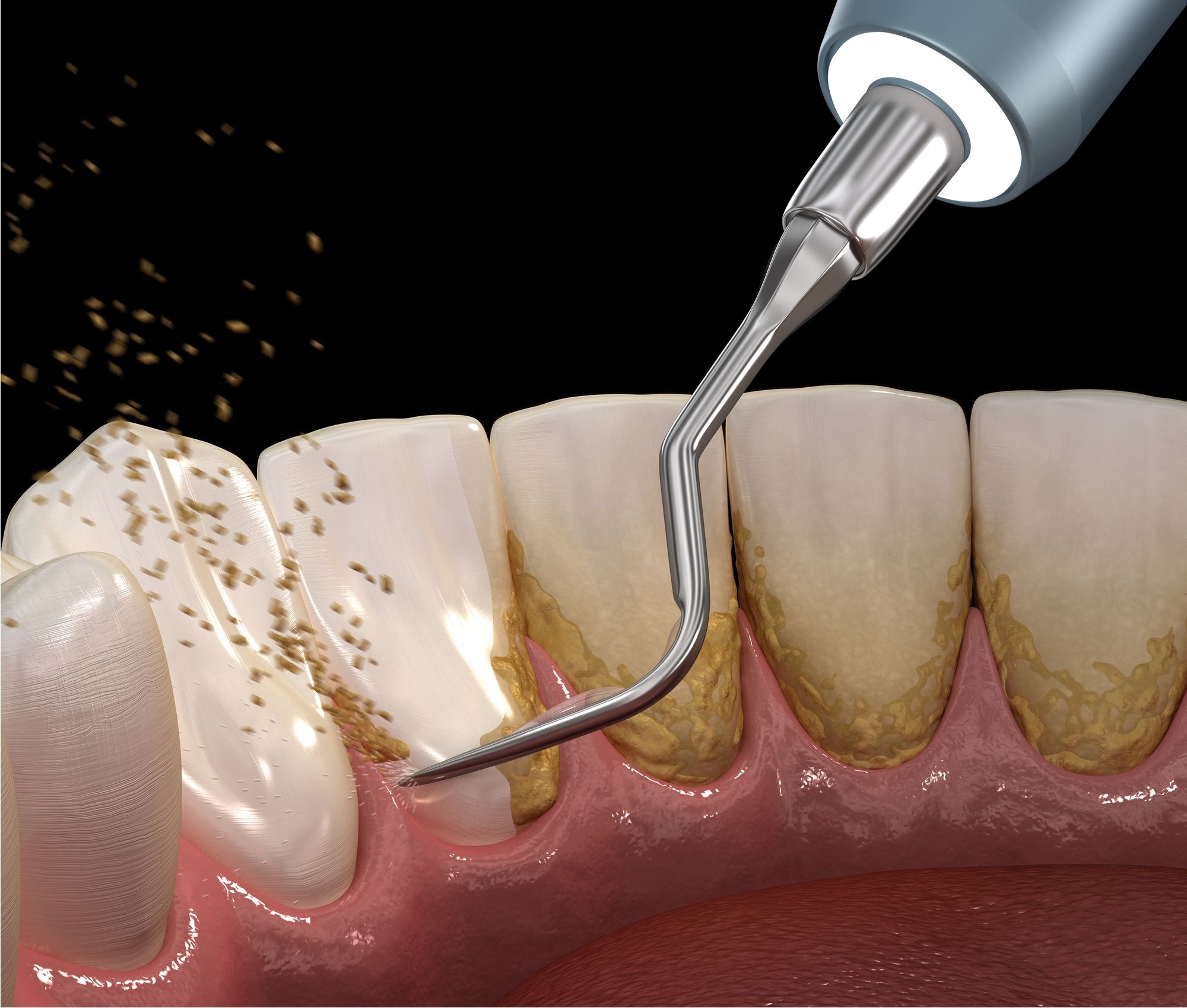 اضرار تبييض الاسنان وتنظيف الاسنان