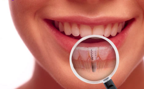 هل تتحرك تركيبات الاسنان بعد الزراعة؟