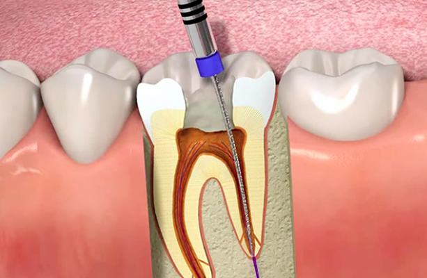 هل يؤلم إجراء زراعة عصب الأسنان؟