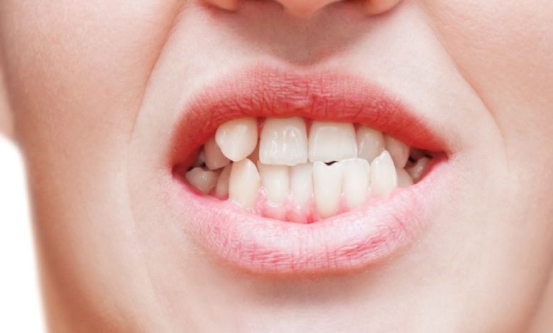 أسباب اعوجاج الأسنان