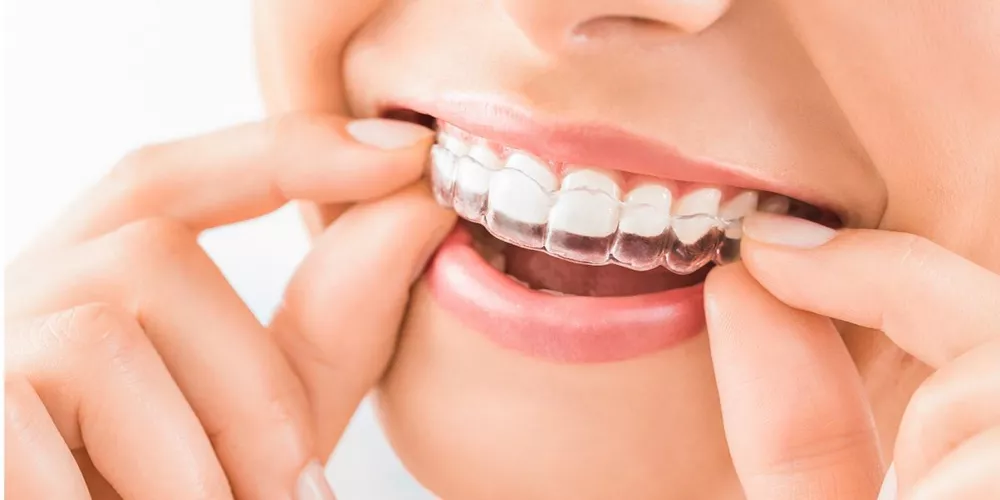 أنواع تقويم الأسنان الغير مرئي