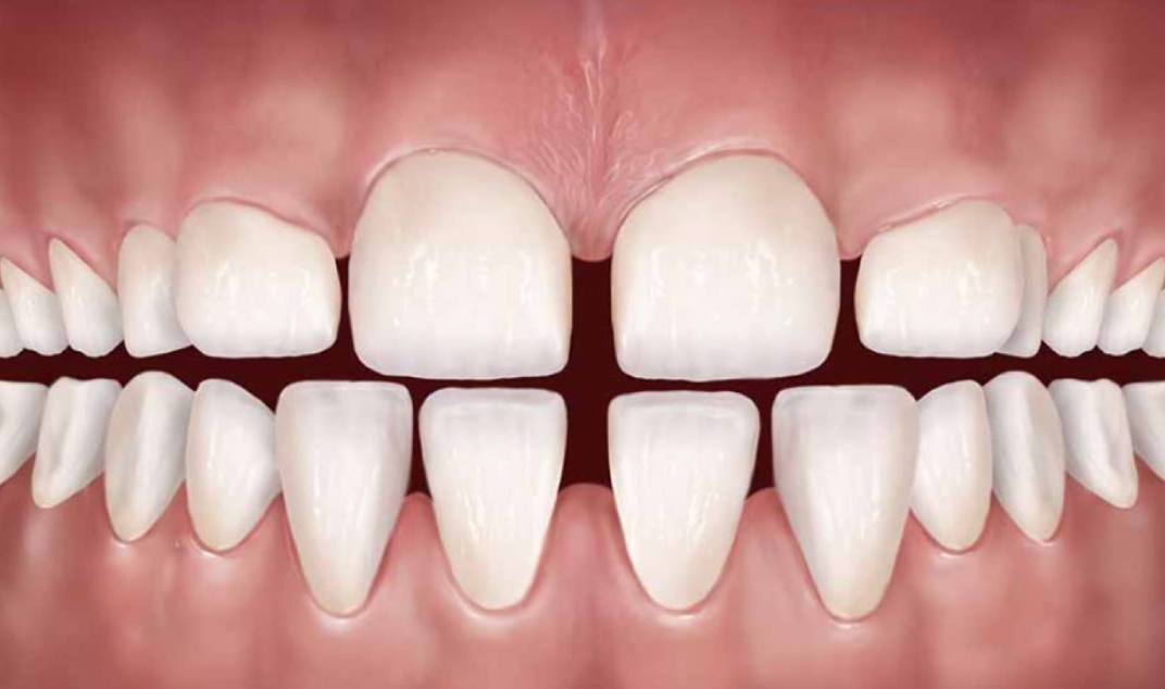 اسباب تجميل الاسنان المتفرقة