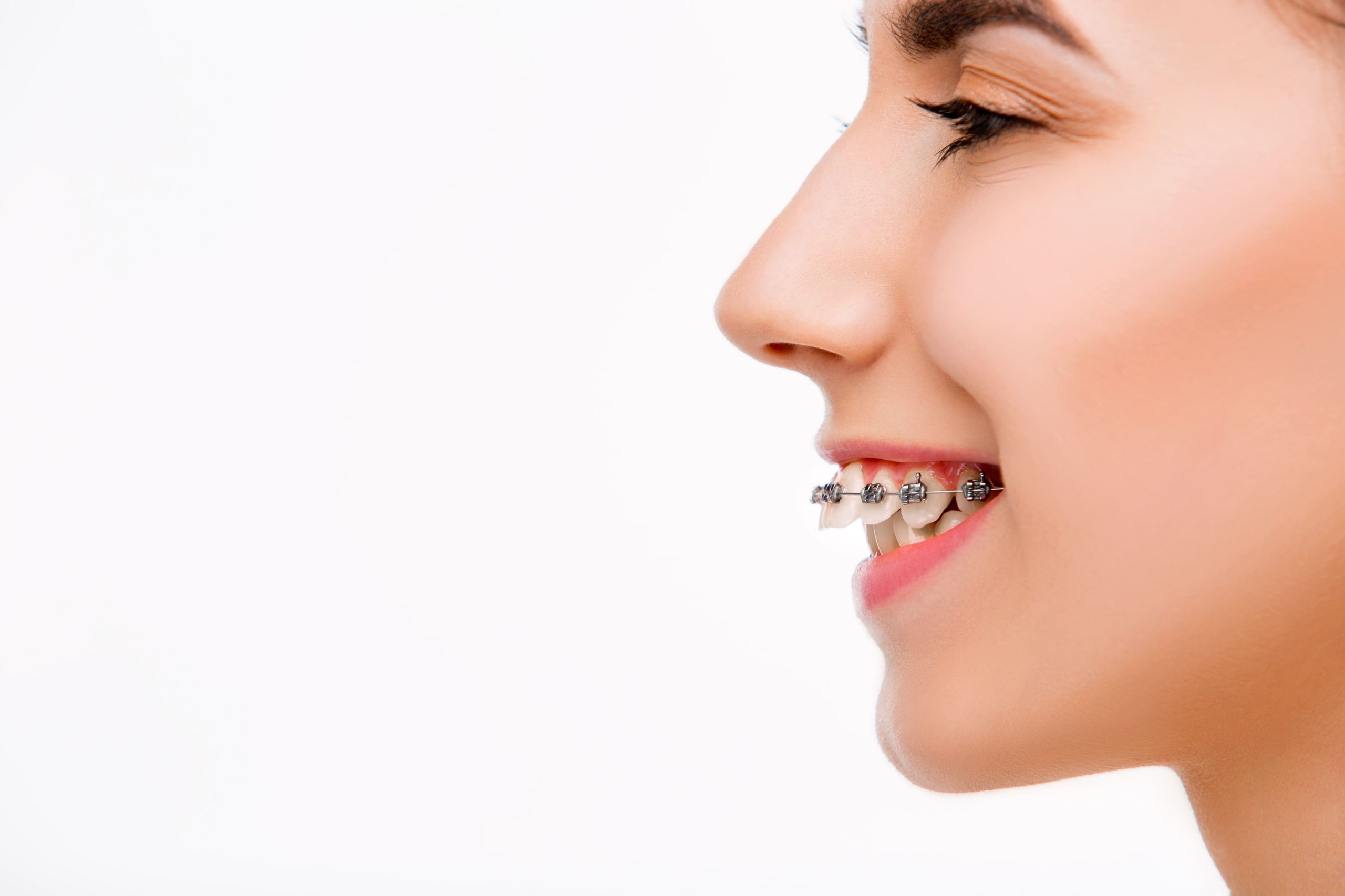 ارتودنسی برای دندان های برجسته