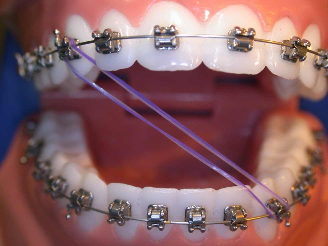 تقويم الاسنان المطاط المتصل